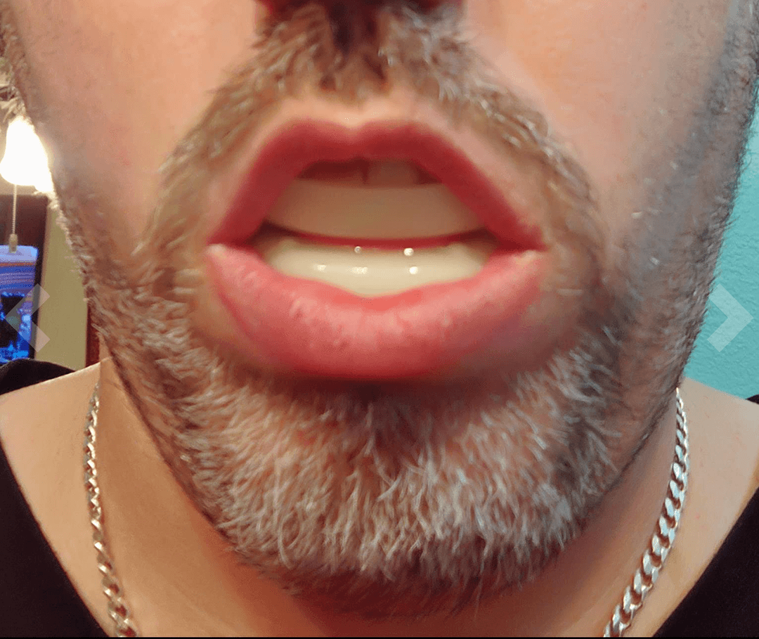 Zyppah Anti Snoring Mouthguard