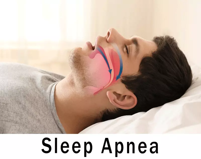  sleep apnea