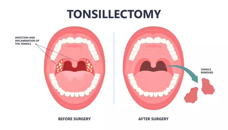  tonsillectomy